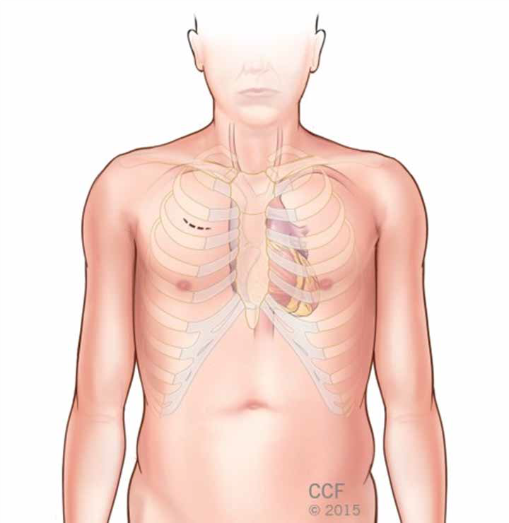 minimally invasive and robotically assisted heart surgery 4.png